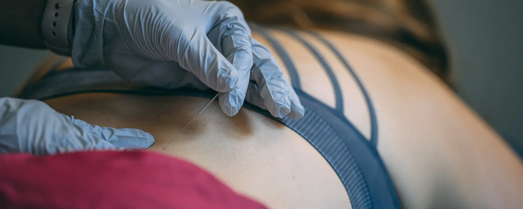 Dry Needling