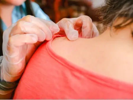 Conditions Treated by Dry Needling - Munger PT