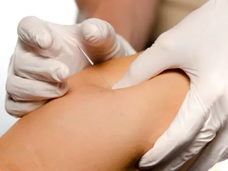 Dry Needling Row 1 - Munger PT