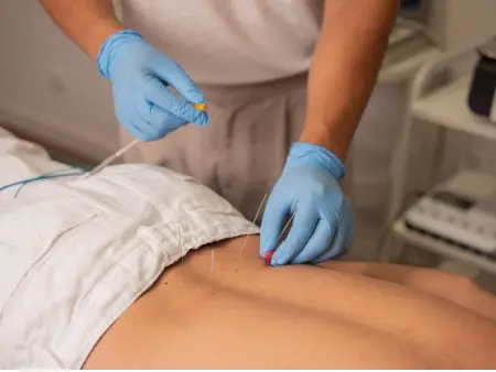 Get Dry Needling Treatment at Munger Physical Therapy - Munger PT
