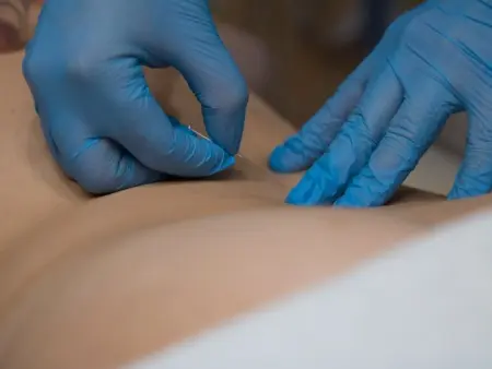 The Act of Dry Needling - Munger PT